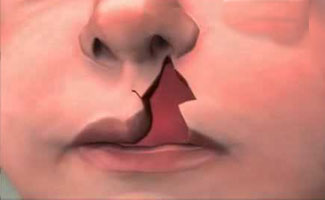 Experts treat 200 cleft lip and palate patients at medical camp