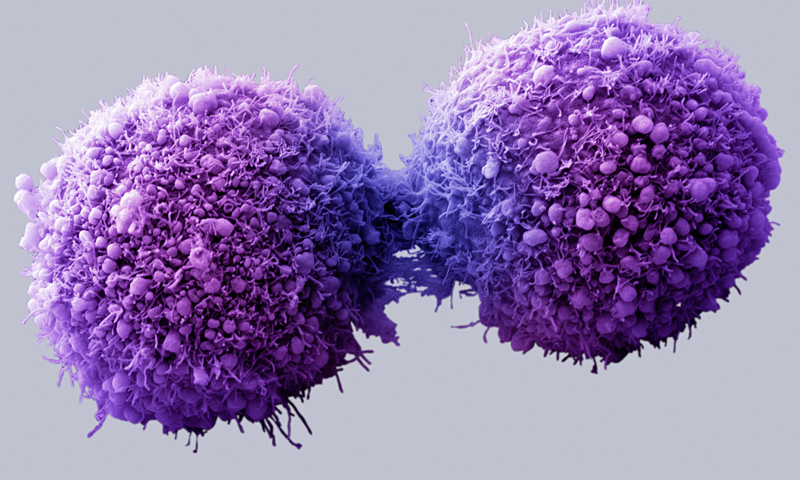 Cancer to kill 5.5 mn women a year by 2030: report