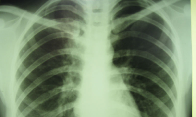More than half million people diagnosed with TB in the country