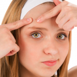 Here's how to cure acne with food!!