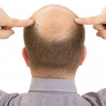 Hair loss linked with defective immune cells