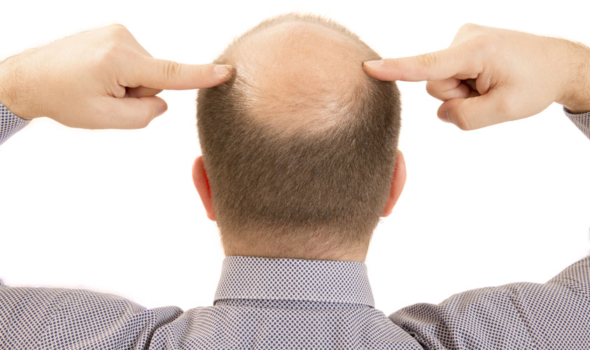 Hair loss linked with defective immune cells