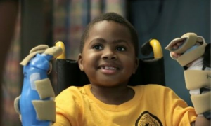 World's first child hand transplant a 'success'