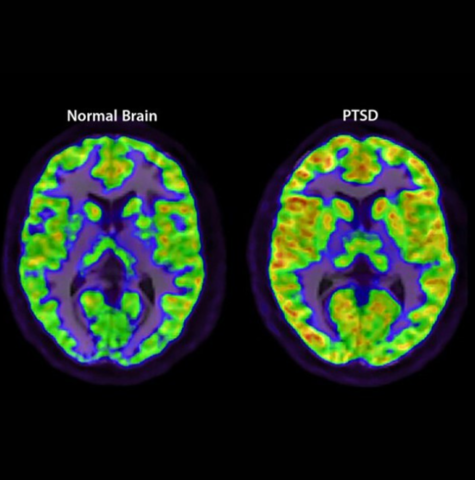 How child abuse survivors have higher risk of PTSD?