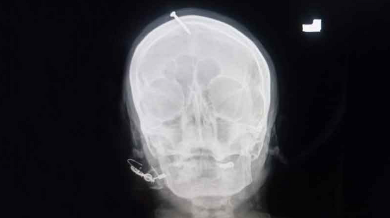 Peshawar "Pir" not responsible for nail in wife&rsquo;s head, claims husband