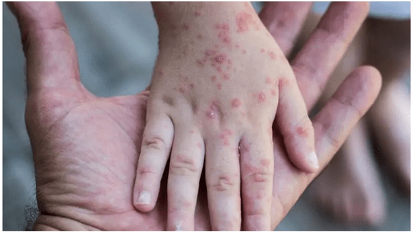 Monkeypox outbreak in Europe &lsquo;largest ever&rsquo; in region as cases cross 100