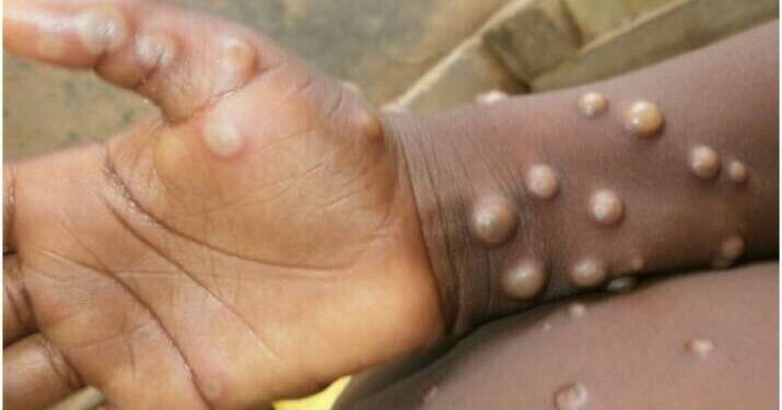 What is Monkeypox and why is it spreading around the world?