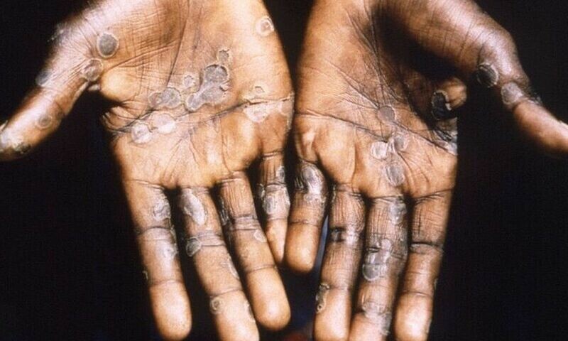 Sindh issues alert for probable spread of monkeypox