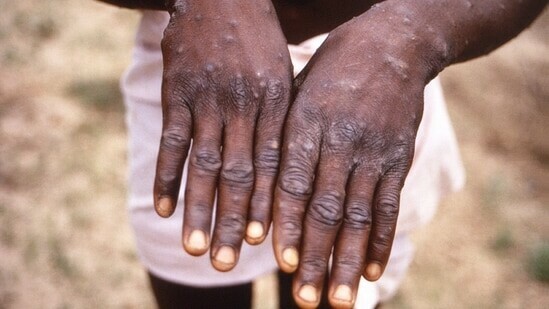 What threat does monkeypox pose and what are its symptoms?