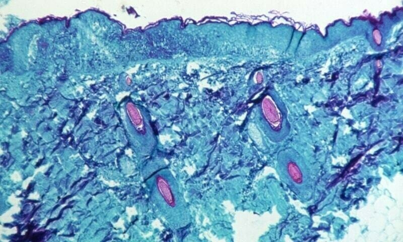 More than 700 monkeypox cases globally, 21 in US: CDC