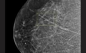 Pakistan has high levels of inherited breast cancer: AKU