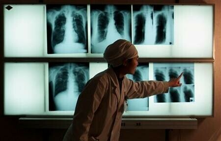 New treatment emerges for drug-resistant TB