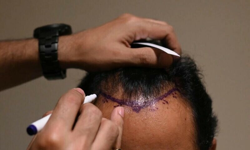 Hair transplant fad turns deadly in India