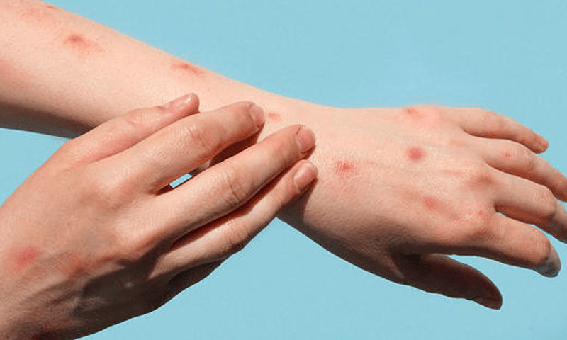 First case of monkeypox detected in Islamabad
