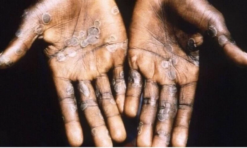 Pakistan reports third case of monkeypox