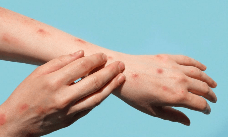 Pakistan&rsquo;s fifth monkeypox case detected in Islamabad