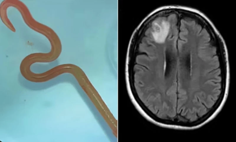 Australian doctors find live parasitic worm in woman&rsquo;s brain