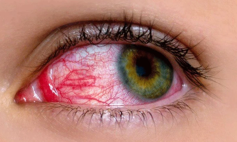 Surge in pink eye cases: Lahore reports 45 new infections