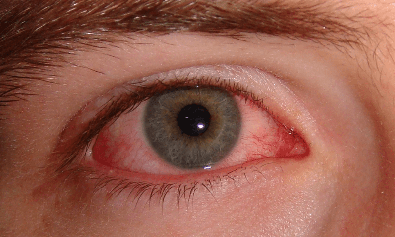 Pink eye infection: Punjab govt issues alert for schools