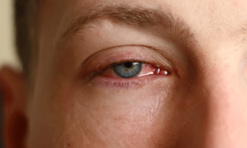 Over 10,000 cases reported as Pink eye outbreak surges in Punjab