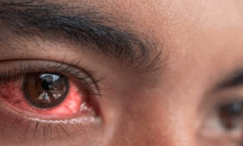 Extra school holidays slow down spread of conjunctivitis