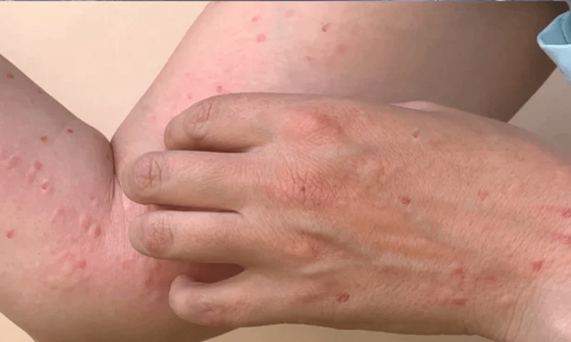 First case of monkey pox reported in Pakistan