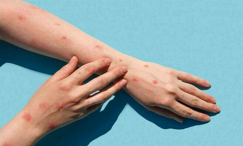 Another mpox case confirmed in Khyber Pakhtunkhwa