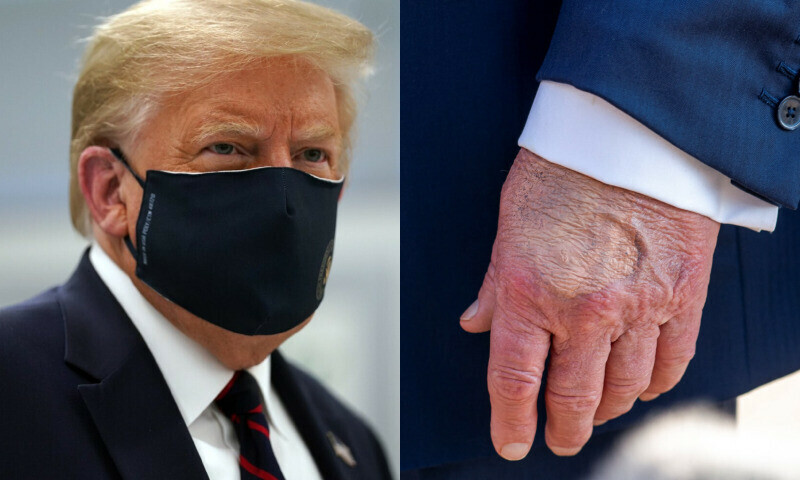 Trump&rsquo;s medical reports diagnosis with common vain disorder