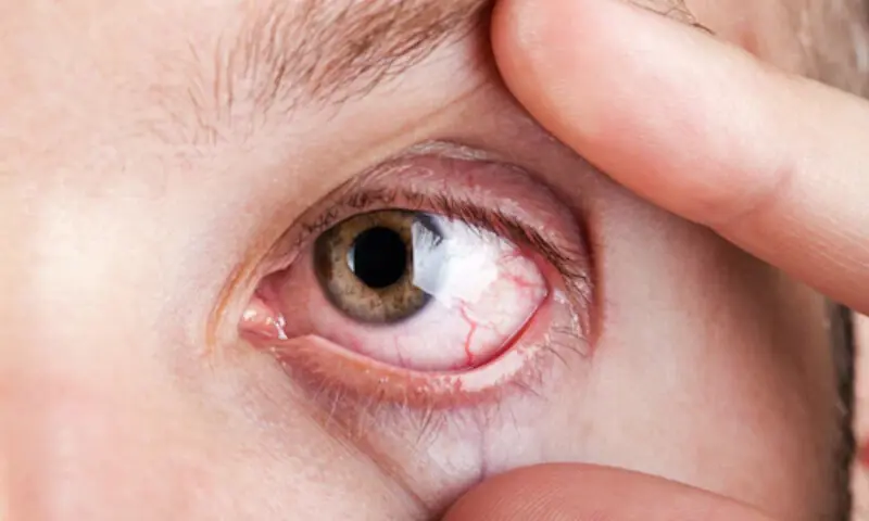 ہائی بلڈ پریشر سے بینائی متاثر ہونے کا خطرہ – Health