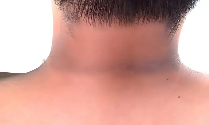 گردن پر سیاہ لکیریں میل نہیں سنگین بیماریوں کی خاموش وارننگ ہیں