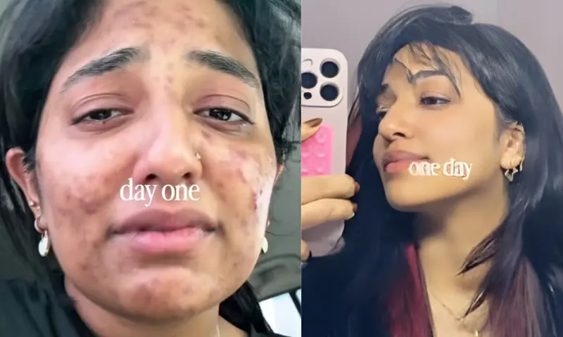 خاتون کی مہاسوں سے صاف اور چمکدار جلد تک حیران کن تبدیلی، وائرل ویڈیو کی سوشل میڈیا پر دھوم