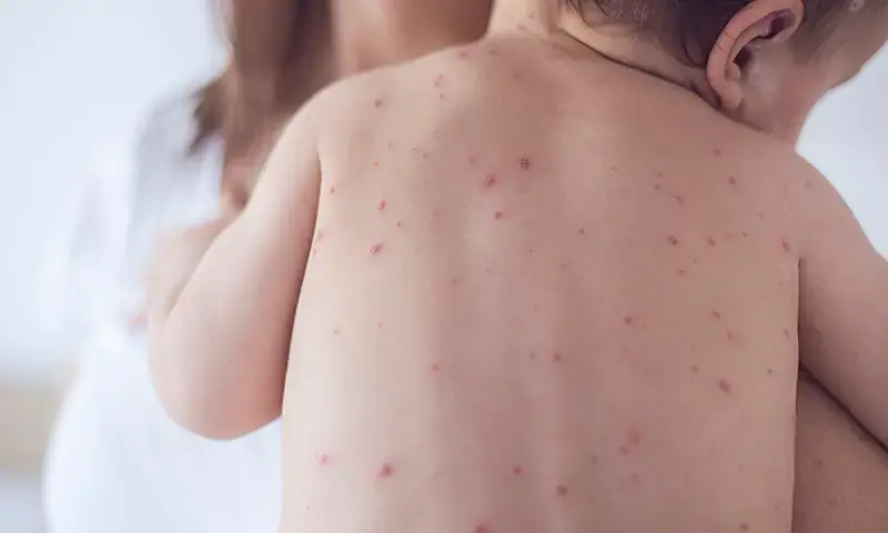 Measles outbreak in Sindh claims 40 children&rsquo;s lives