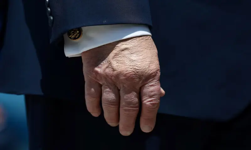 Trump in excellent health with leg swelling, hand bruising, doctor says