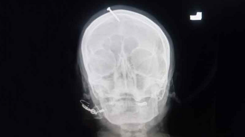 Peshawar &lsquo;pir&rsquo; hammers nail into pregnant woman&rsquo;s head