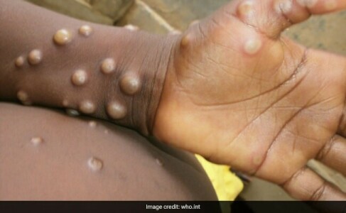 Canada reports dozen suspected cases of rare monkeypox virus