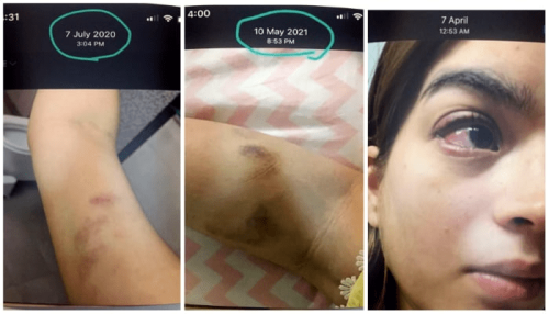 Aliza Sultan&rsquo;s bruises, medical report tell a tale of domestic violence