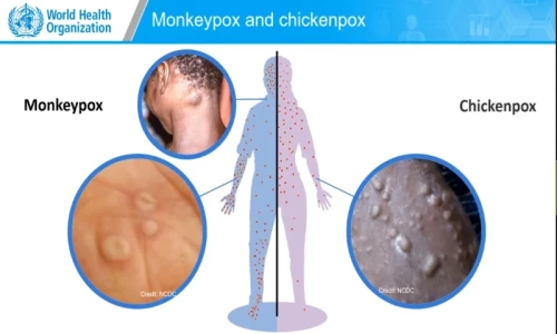 Karachi suspected monkeypox case &lsquo;turns out&rsquo; to be chickenpox