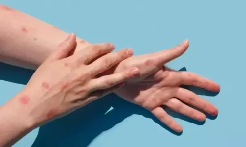 Four deportees with suspects monkeypox cases escape from airport