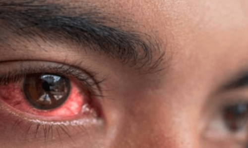 Extra school holidays slow down spread of conjunctivitis