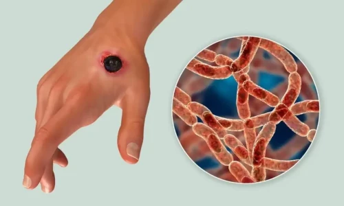 Cutaneous anthrax, transmitted from animals, found in 5 people in China