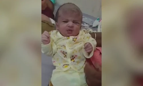 Surgeons in Faisalabad successfully operate on 10-day-old girl with two brains