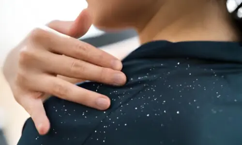 سردیوں میں بالوں کی خشکی اور کھجلی سے کیسے نجات پائیں؟