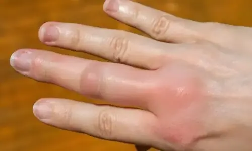 سردیوں میں ہاتھ اور پیر کیوں سوج جاتے ہیں؟