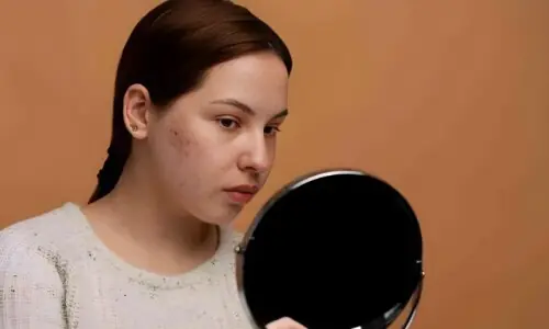 سردیوں میں کیل مہاسے زیادہ کیوں ہوتے ہیں؟ سردیوں میں کیل مہاسے زیادہ کیوں ہوتے ہیں؟