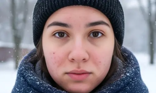 سردیوں میں کیل مہاسے زیادہ کیوں ہوتے ہیں؟