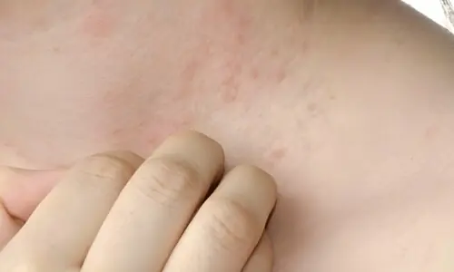 گرمی دانے ایک سے دوسرے کو نہیں لگتے تو پھر اتنے لوگ متاثر کیوں ہوتے ہیں؟