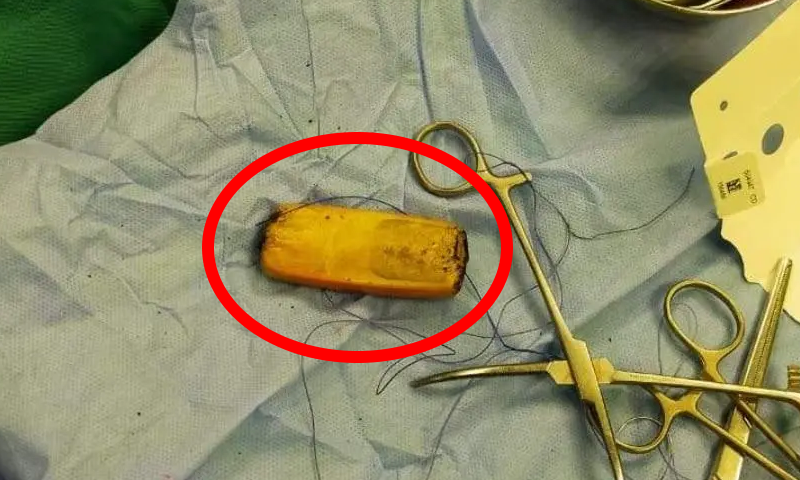 مصر: مرییض کے پیٹ سے موبائل فون چھ ماہ بعد نکال لیا گیا