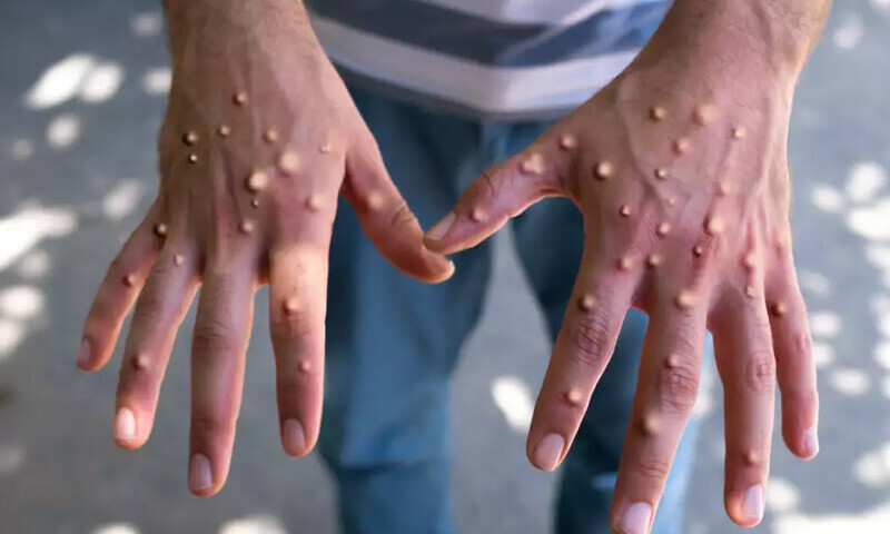 پاکستان آنے والے چار مسافروں میں منکی پاکس کی تصدیق نہ ہوسکی