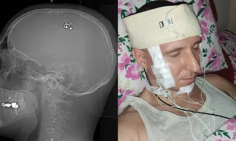 روسی محقق نے خوابوں پرکنٹرول کے لیے اپنے ہی دماغ کی سرجری کرڈالی