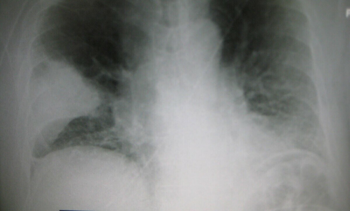 پنجاب میں نمونیہ سے 13 بچے جاں بحق